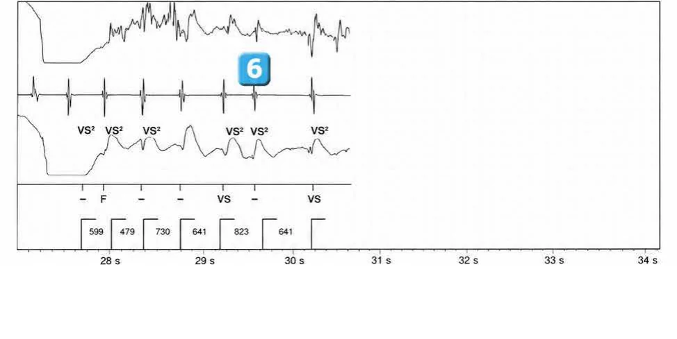 Abbott ICD electrogram, segment 5 of 5 — Anti-tachycardia pacing during or before charging in the VF zone