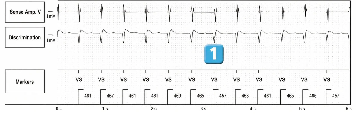 Abbott ICD electrogram, segment 1 of 5 — ATP during charging and acceleration of tachycardia