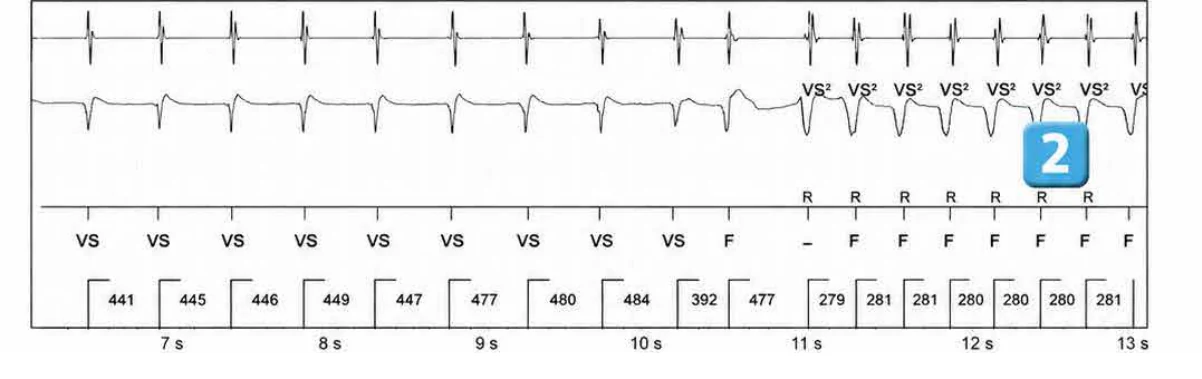 Abbott ICD electrogram, segment 2 of 5 — ATP during charging and acceleration of tachycardia