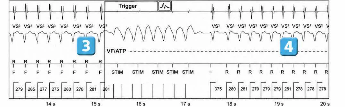Abbott ICD electrogram, segment 3 of 5 — ATP during charging and acceleration of tachycardia