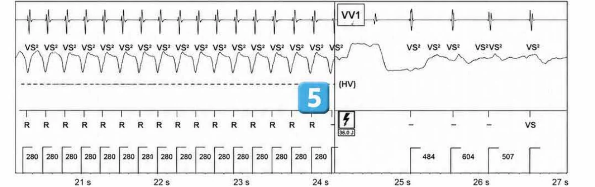 Abbott ICD electrogram, segment 4 of 5 — ATP during charging and acceleration of tachycardia