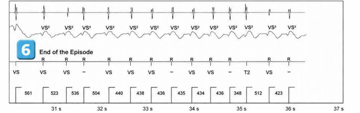 Abbott ICD electrogram, segment 5 of 5 — ATP during charging and acceleration of tachycardia