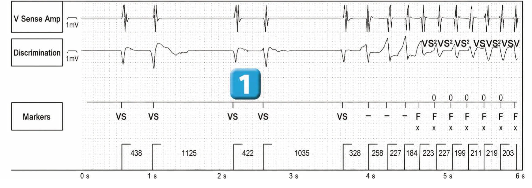 Abbott ICD electrogram, segment 1 of 4 — ATP during charging and acceleration of tachycardia