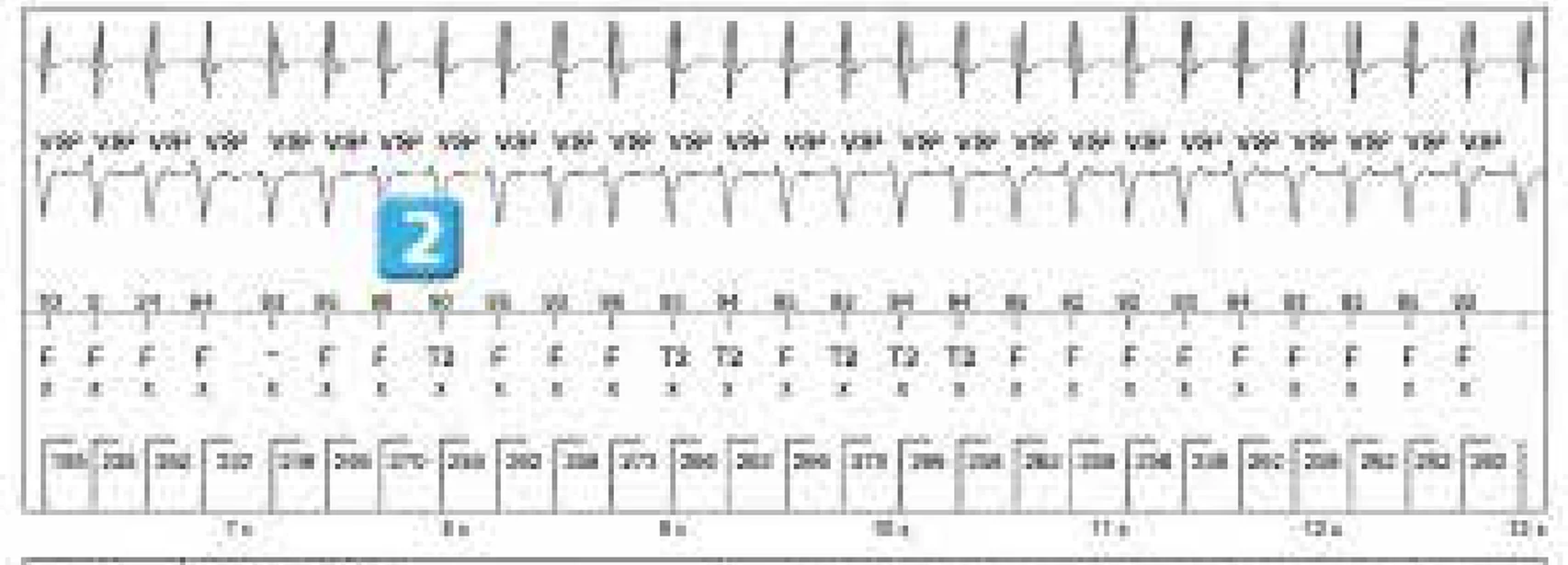 Abbott ICD electrogram, segment 2 of 4 — ATP during charging and acceleration of tachycardia