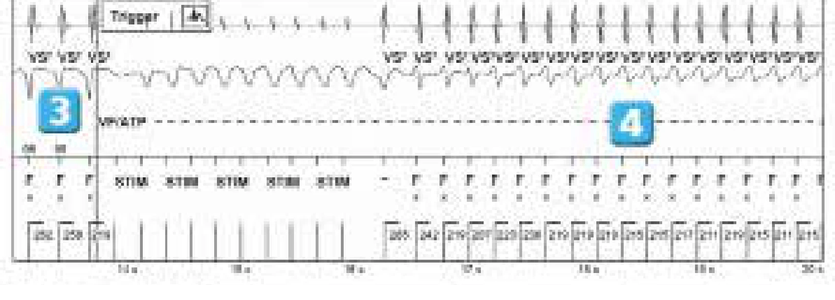 Abbott ICD electrogram, segment 3 of 4 — ATP during charging and acceleration of tachycardia