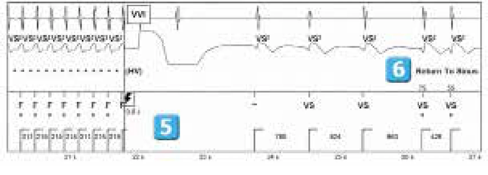 Abbott ICD electrogram, segment 4 of 4 — ATP during charging and acceleration of tachycardia