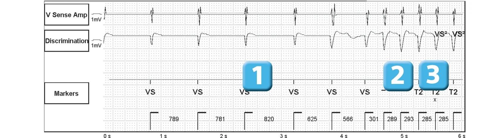 Abbott ICD electrogram, segment 1 of 3 — Sequence of therapies in the VT zone