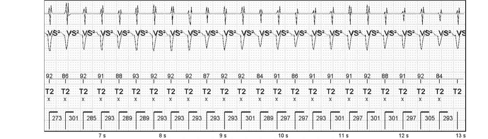 Abbott ICD electrogram, segment 2 of 3 — Sequence of therapies in the VT zone