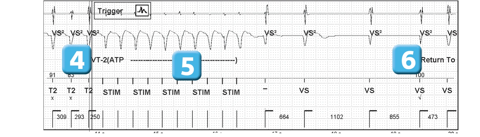 Abbott ICD electrogram, segment 3 of 3 — Sequence of therapies in the VT zone