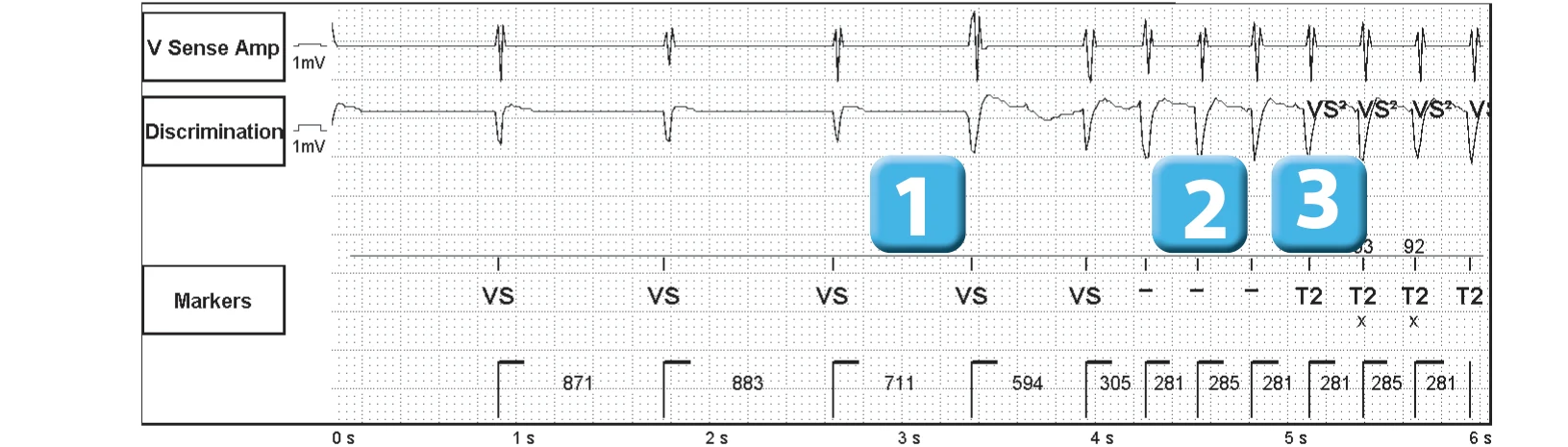 Abbott ICD electrogram, segment 1 of 5 — Sequence of therapies in the VT zone