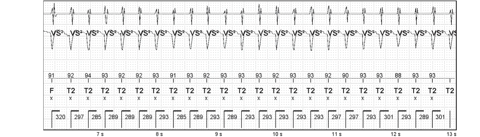 Abbott ICD electrogram, segment 2 of 5 — Sequence of therapies in the VT zone