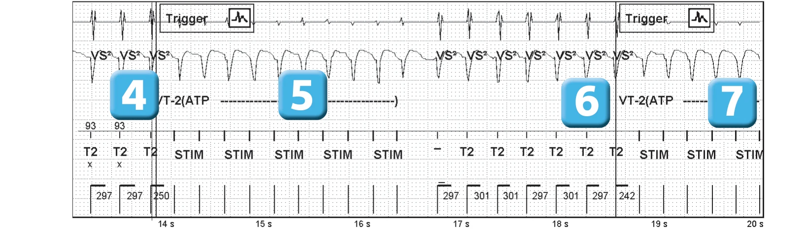 Abbott ICD electrogram, segment 3 of 5 — Sequence of therapies in the VT zone