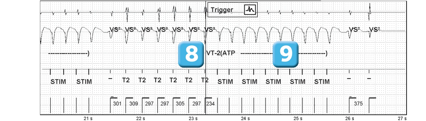Abbott ICD electrogram, segment 4 of 5 — Sequence of therapies in the VT zone