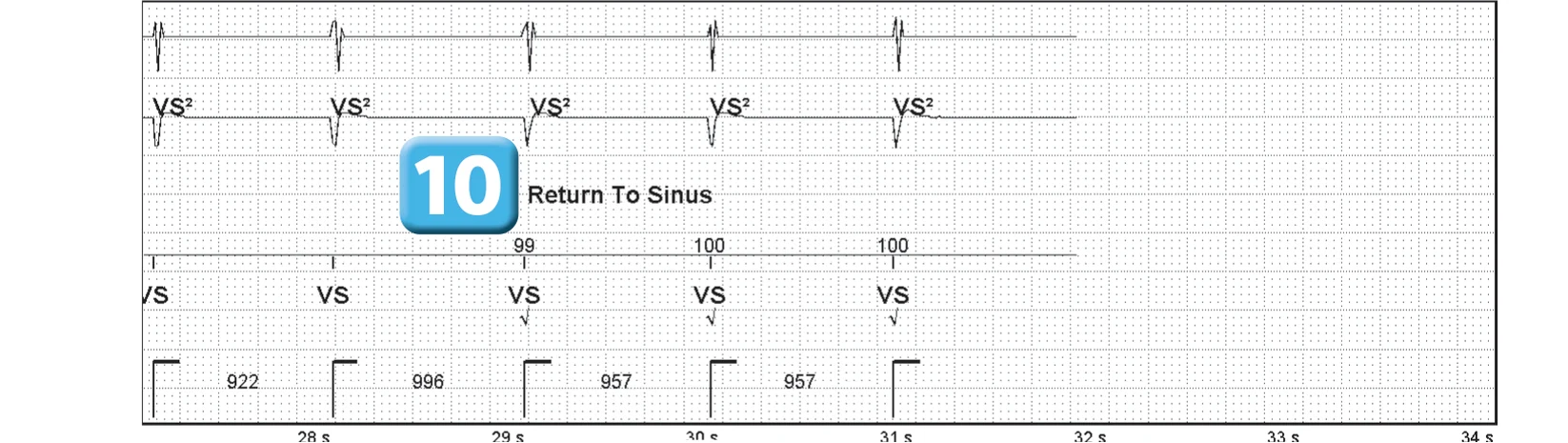 Abbott ICD electrogram, segment 5 of 5 — Sequence of therapies in the VT zone