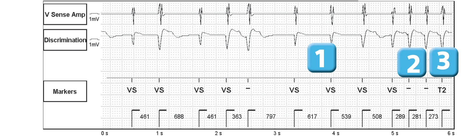 Abbott ICD electrogram, segment 1 of 7 — Sequence of therapies in the VT zone