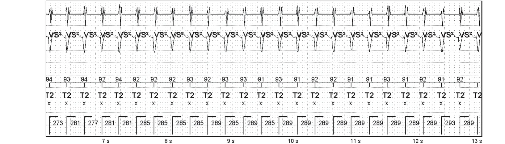 Abbott ICD electrogram, segment 2 of 7 — Sequence of therapies in the VT zone