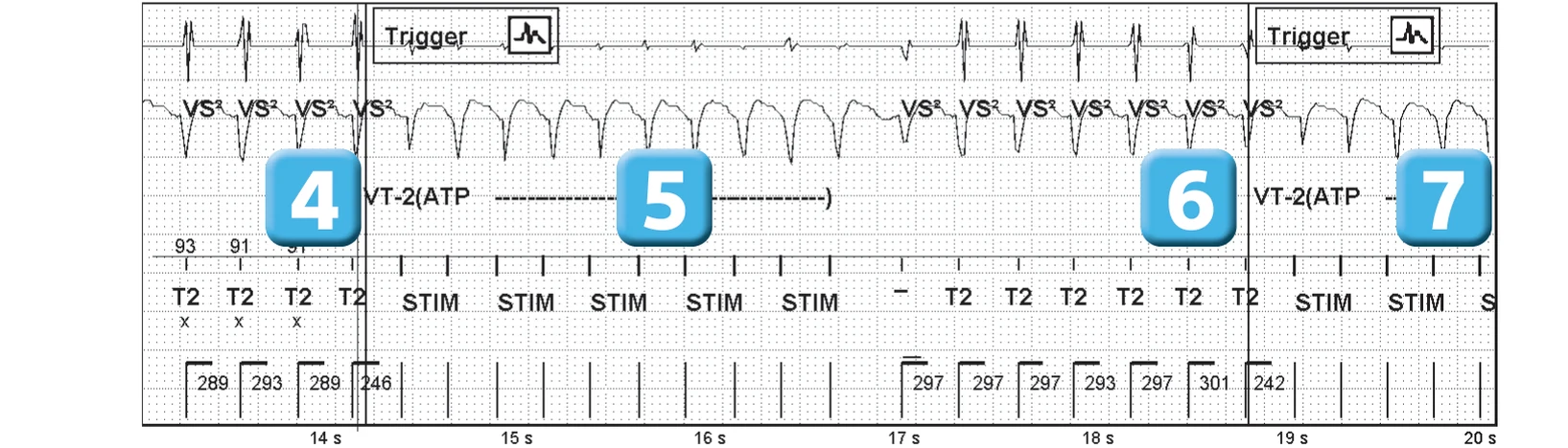 Abbott ICD electrogram, segment 3 of 7 — Sequence of therapies in the VT zone