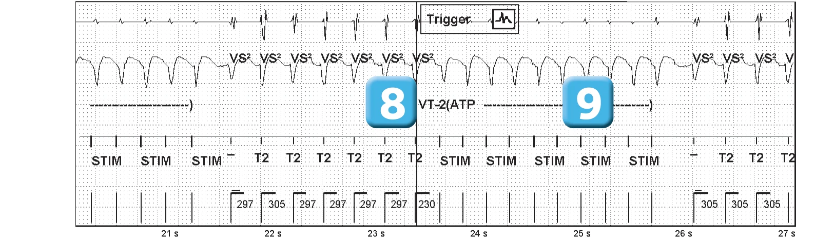 Abbott ICD electrogram, segment 4 of 7 — Sequence of therapies in the VT zone
