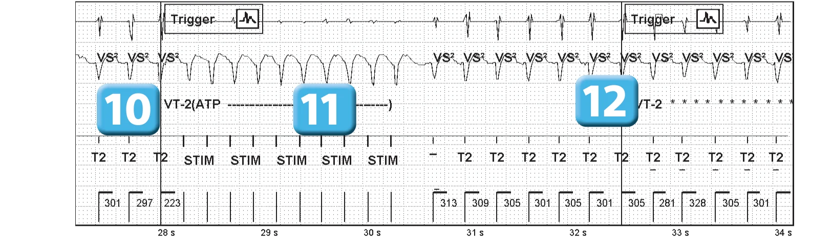 Abbott ICD electrogram, segment 5 of 7 — Sequence of therapies in the VT zone