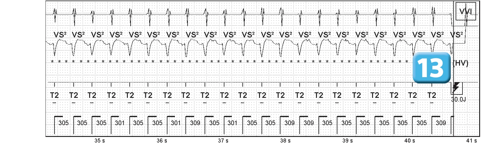 Abbott ICD electrogram, segment 6 of 7 — Sequence of therapies in the VT zone