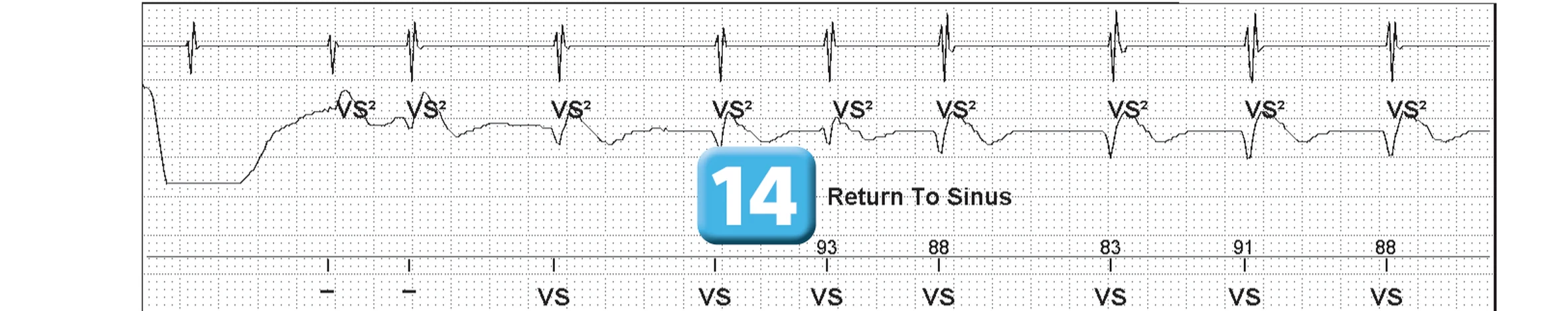 Abbott ICD electrogram, segment 7 of 7 — Sequence of therapies in the VT zone