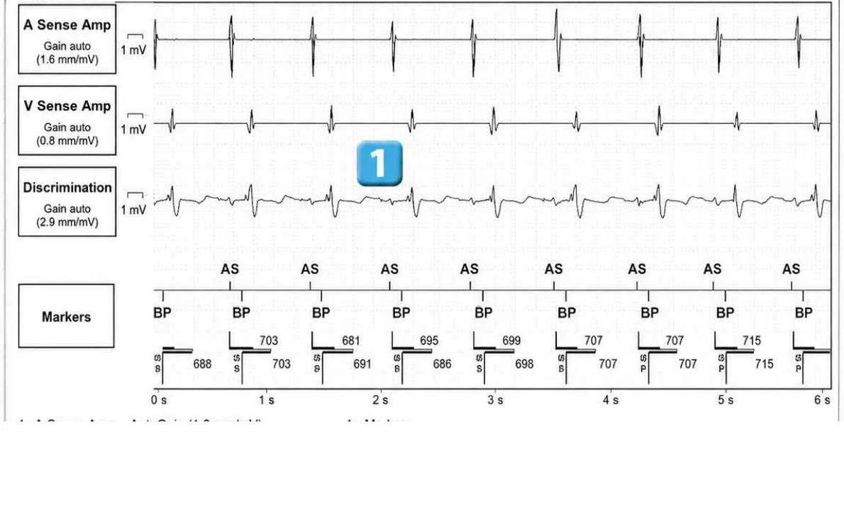 Abbott ICD electrogram, segment 1 of 29 — Acceleration of VT by anti-tachycardia pacing and high defibrillation threshold