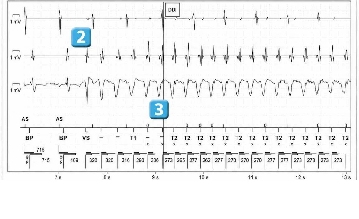 Abbott ICD electrogram, segment 2 of 29 — Acceleration of VT by anti-tachycardia pacing and high defibrillation threshold