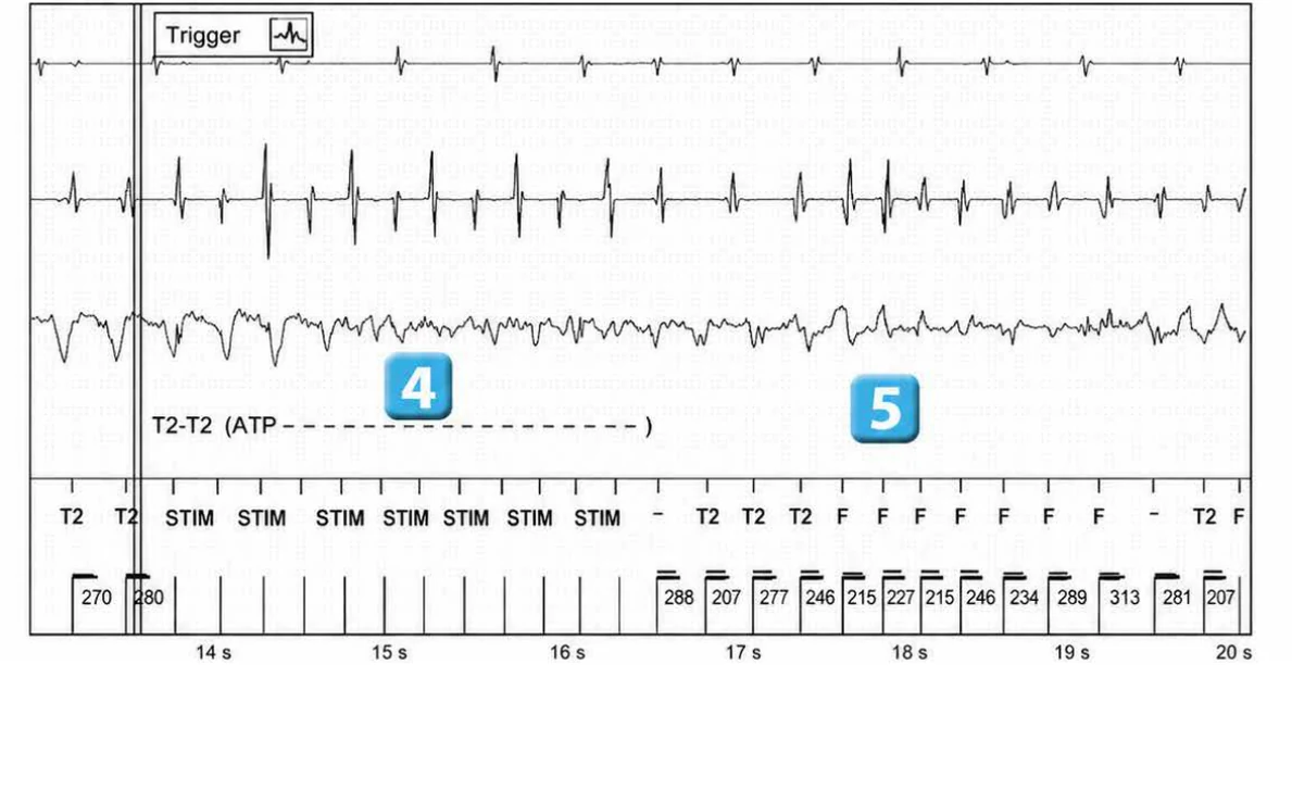 Abbott ICD electrogram, segment 3 of 29 — Acceleration of VT by anti-tachycardia pacing and high defibrillation threshold