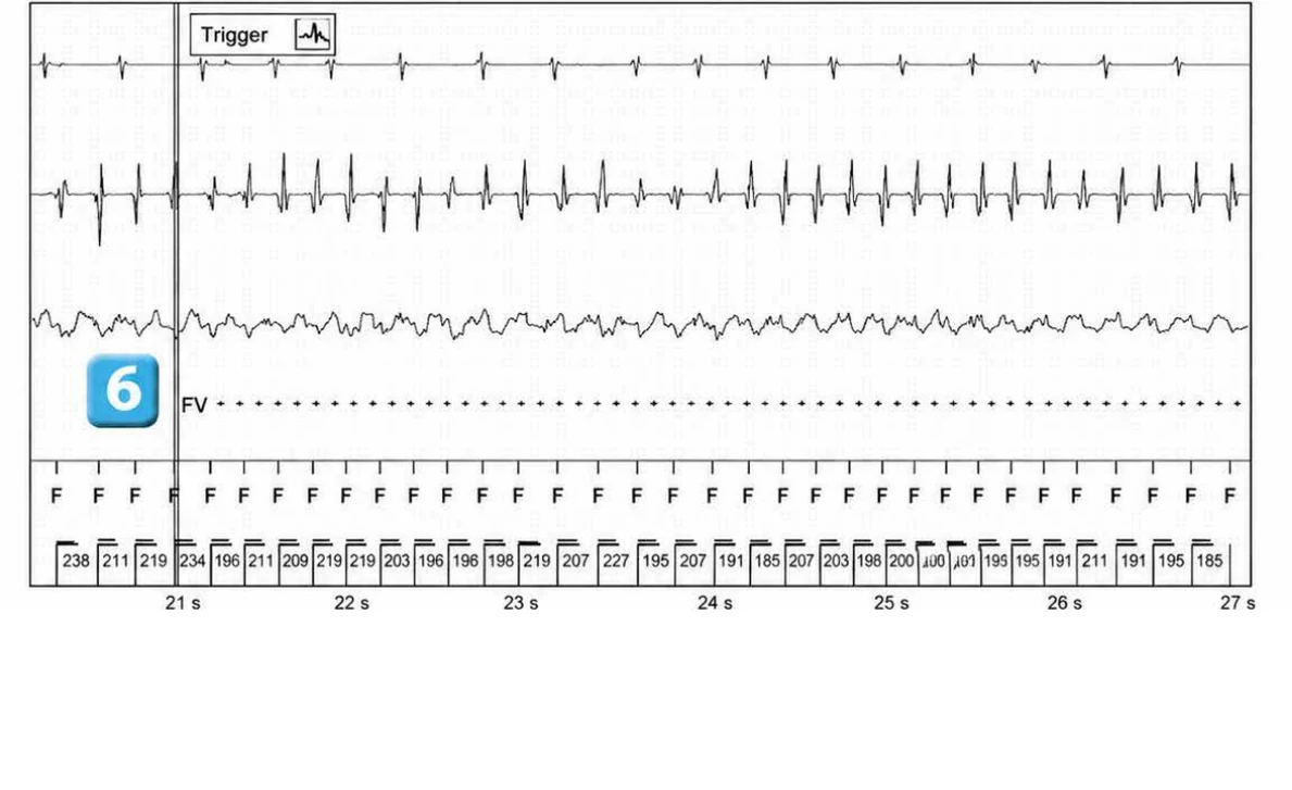 Abbott ICD electrogram, segment 4 of 29 — Acceleration of VT by anti-tachycardia pacing and high defibrillation threshold