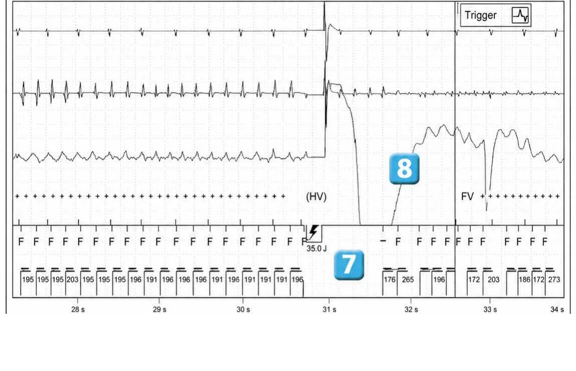 Abbott ICD electrogram, segment 5 of 29 — Acceleration of VT by anti-tachycardia pacing and high defibrillation threshold