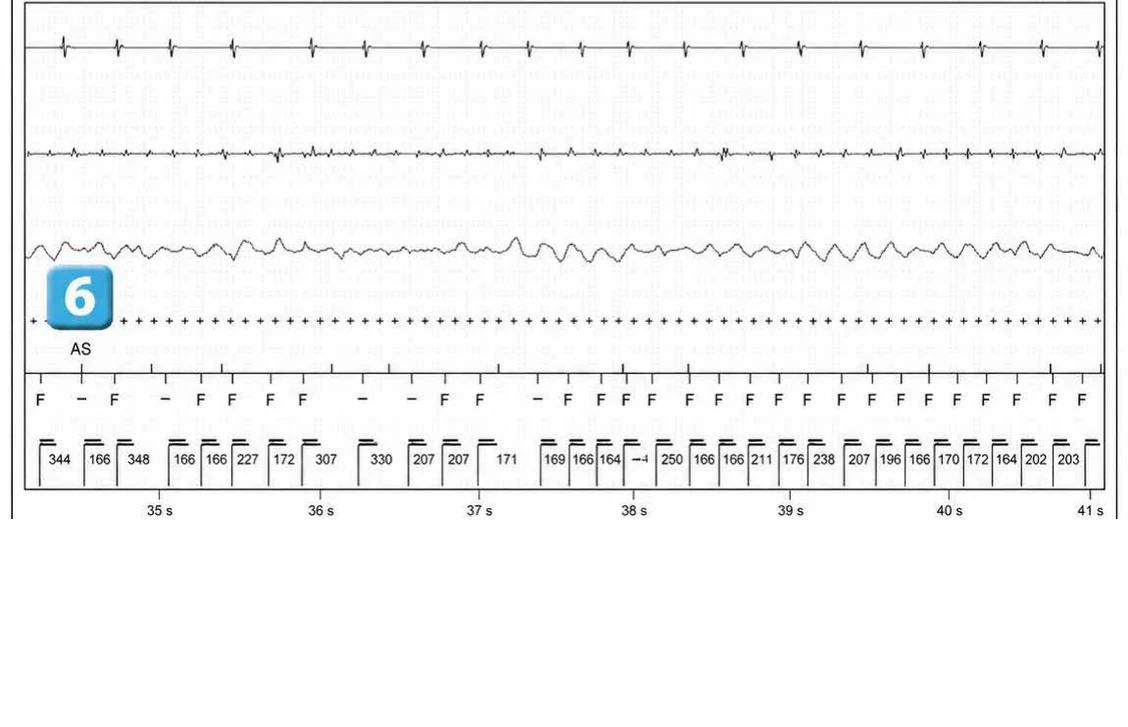 Abbott ICD electrogram, segment 6 of 29 — Acceleration of VT by anti-tachycardia pacing and high defibrillation threshold