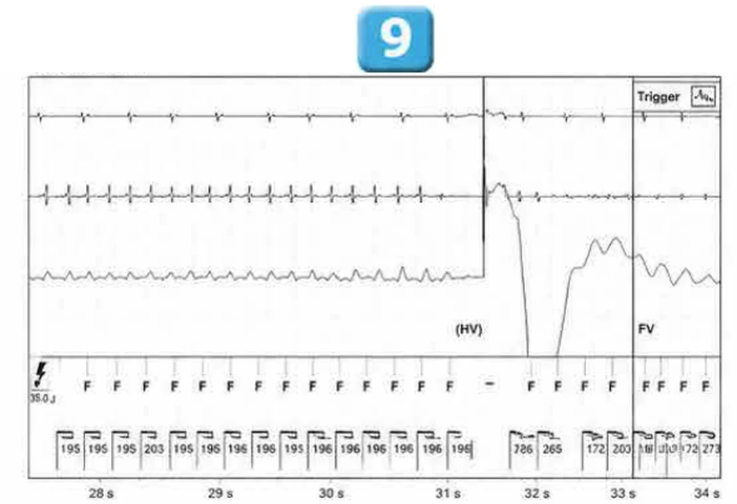 Abbott ICD electrogram, segment 7 of 29 — Acceleration of VT by anti-tachycardia pacing and high defibrillation threshold