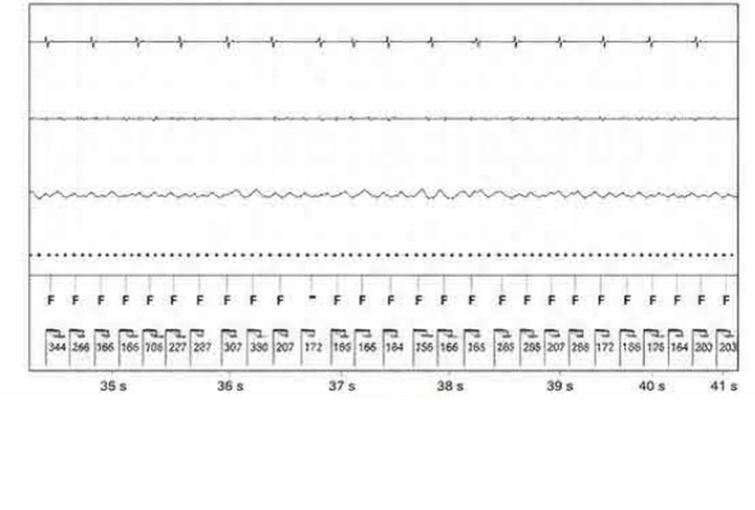 Abbott ICD electrogram, segment 8 of 29 — Acceleration of VT by anti-tachycardia pacing and high defibrillation threshold