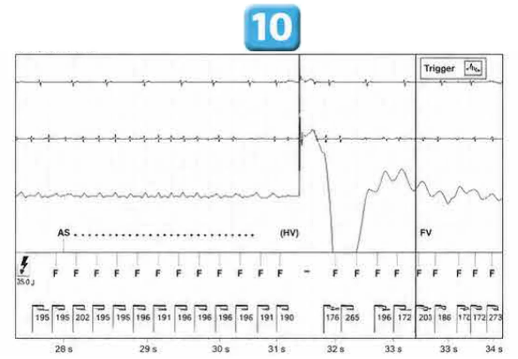 Abbott ICD electrogram, segment 9 of 29 — Acceleration of VT by anti-tachycardia pacing and high defibrillation threshold
