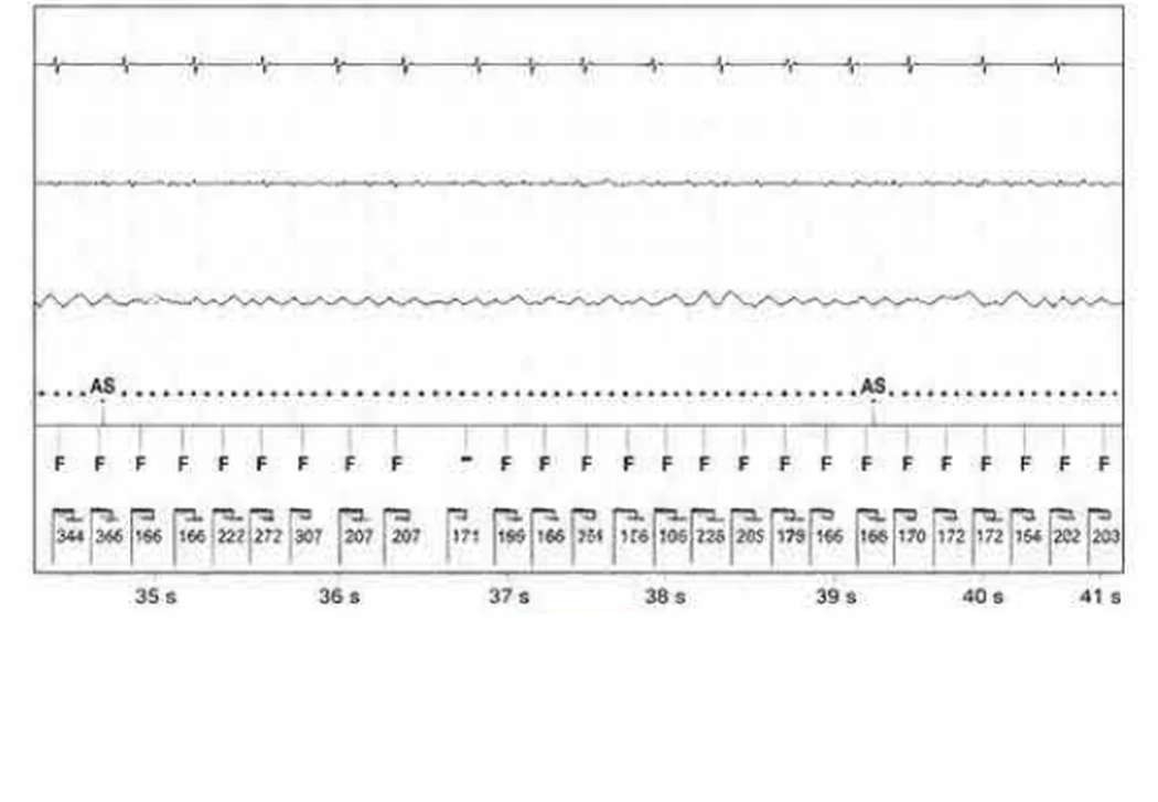 Abbott ICD electrogram, segment 10 of 29 — Acceleration of VT by anti-tachycardia pacing and high defibrillation threshold