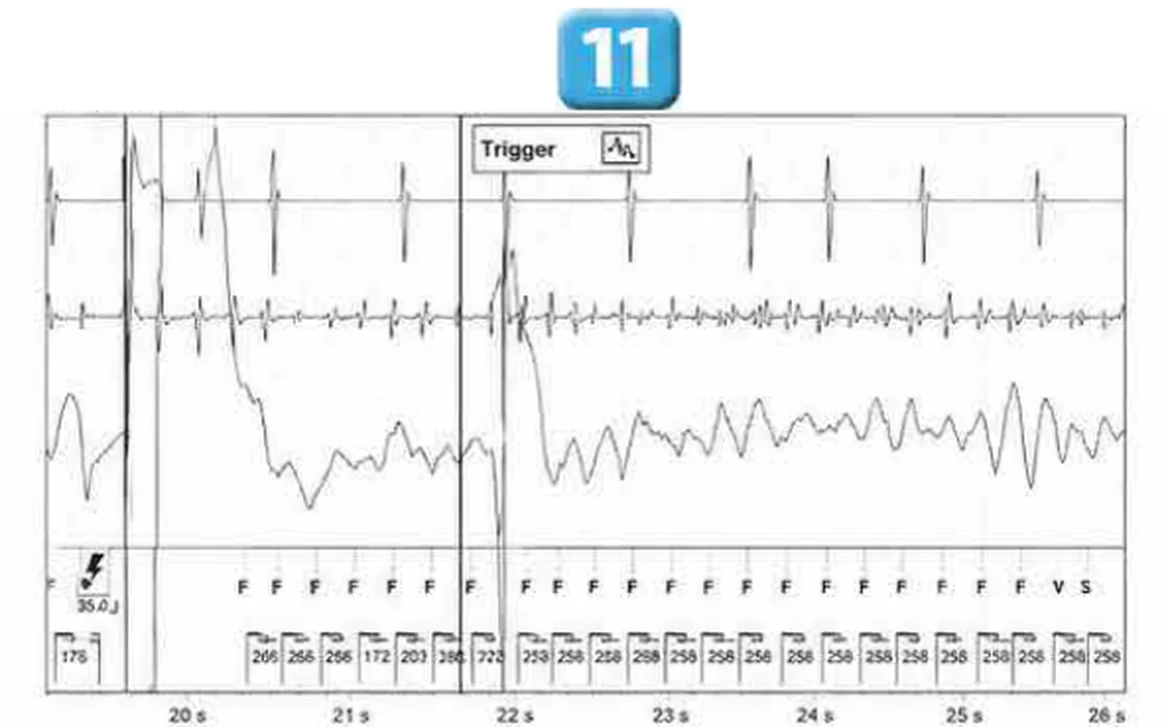 Abbott ICD electrogram, segment 11 of 29 — Acceleration of VT by anti-tachycardia pacing and high defibrillation threshold