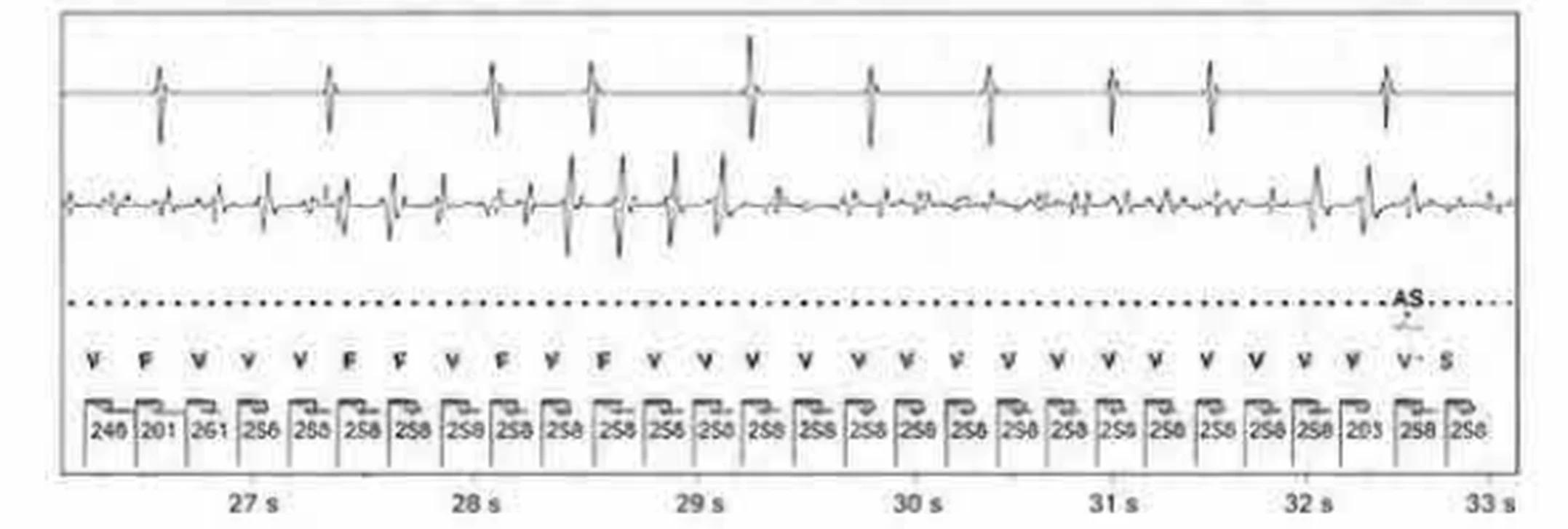 Abbott ICD electrogram, segment 12 of 29 — Acceleration of VT by anti-tachycardia pacing and high defibrillation threshold