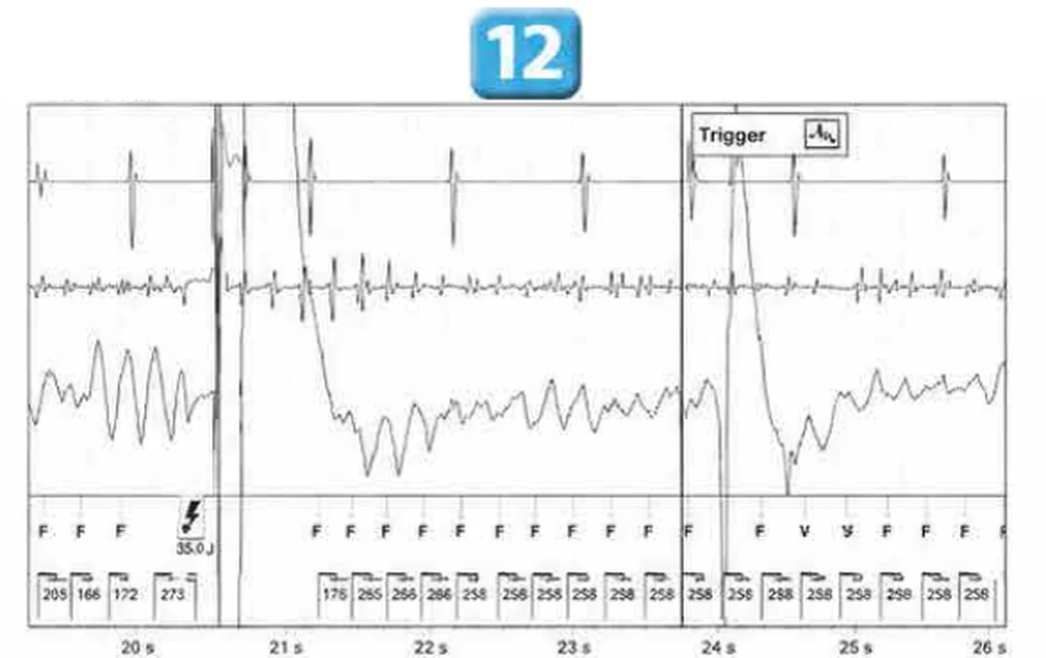 Abbott ICD electrogram, segment 13 of 29 — Acceleration of VT by anti-tachycardia pacing and high defibrillation threshold
