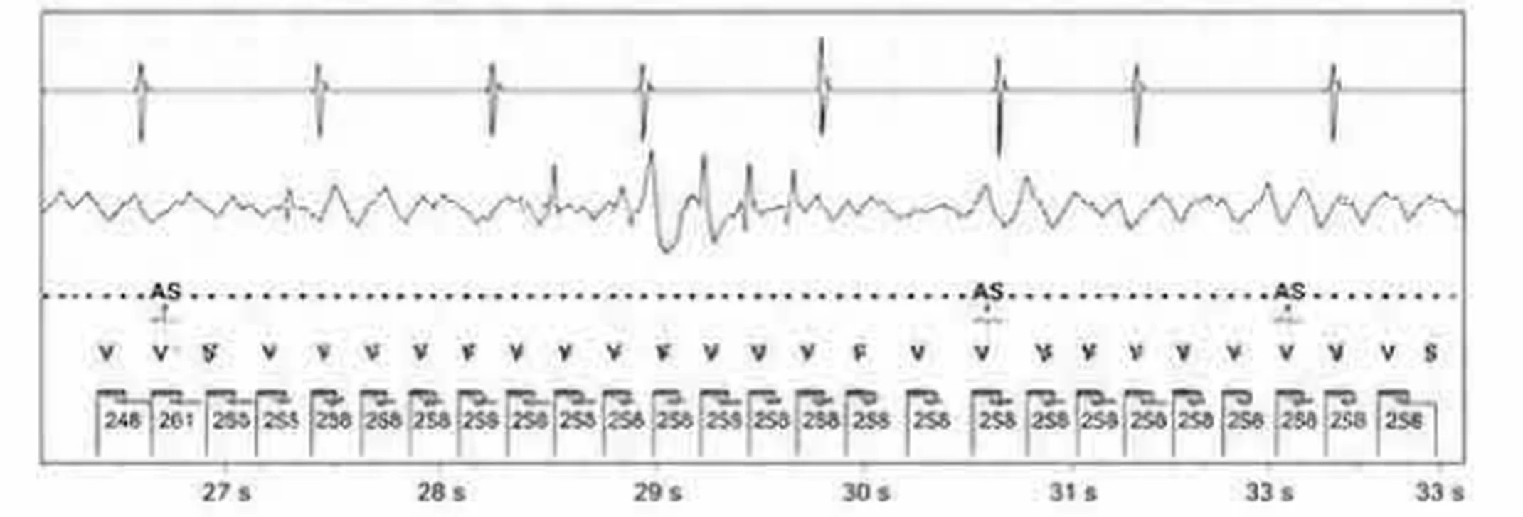 Abbott ICD electrogram, segment 14 of 29 — Acceleration of VT by anti-tachycardia pacing and high defibrillation threshold