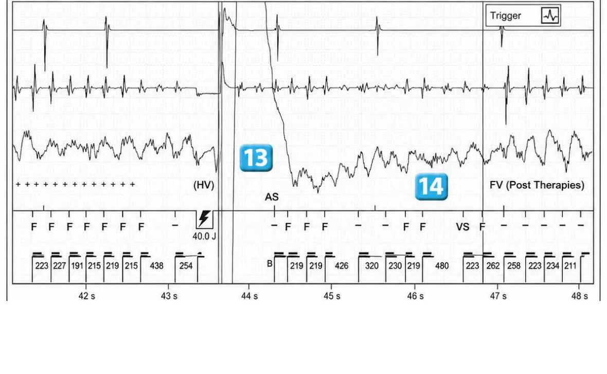 Abbott ICD electrogram, segment 15 of 29 — Acceleration of VT by anti-tachycardia pacing and high defibrillation threshold