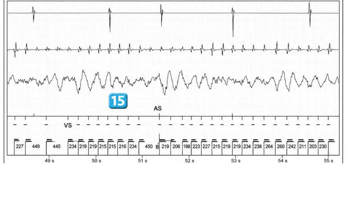Abbott ICD electrogram, segment 16 of 29 — Acceleration of VT by anti-tachycardia pacing and high defibrillation threshold