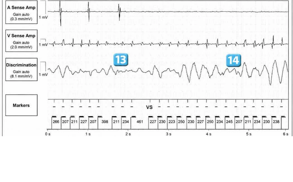 Abbott ICD electrogram, segment 17 of 29 — Acceleration of VT by anti-tachycardia pacing and high defibrillation threshold