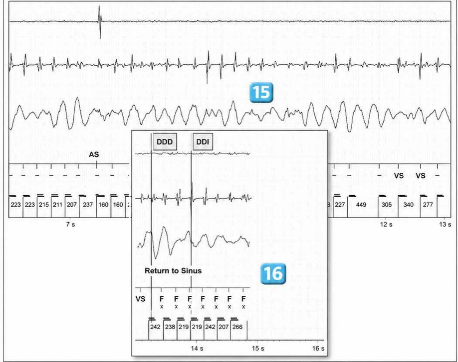 Abbott ICD electrogram, segment 18 of 29 — Acceleration of VT by anti-tachycardia pacing and high defibrillation threshold