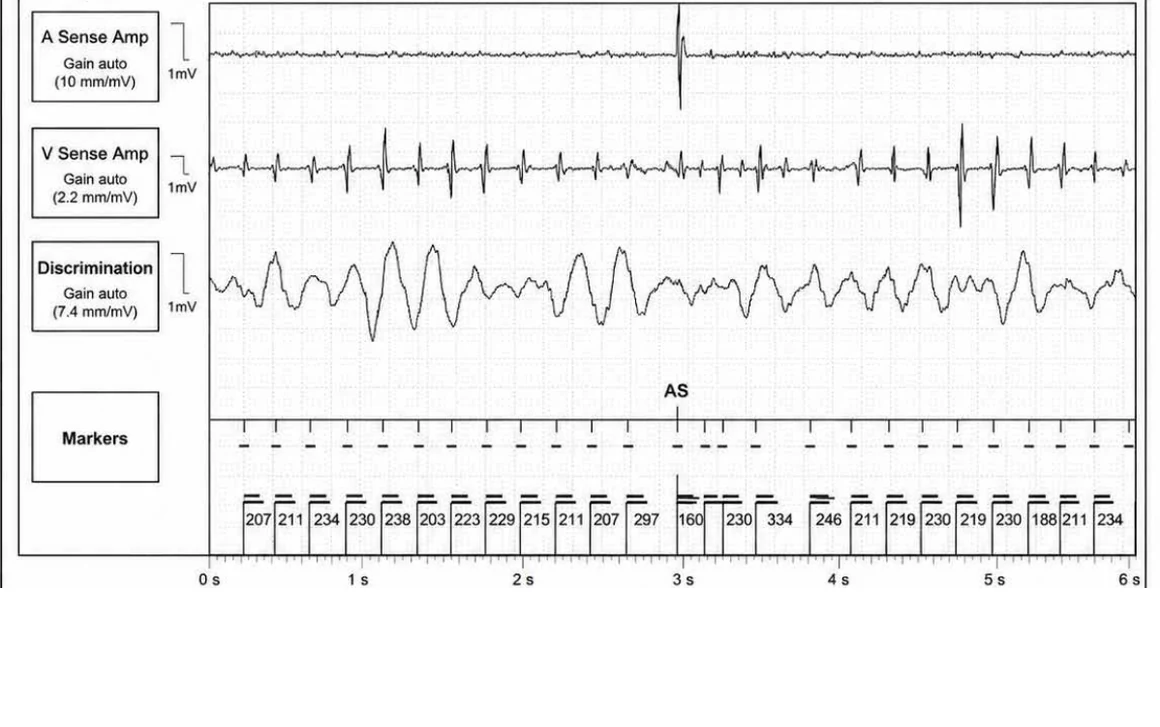 Abbott ICD electrogram, segment 19 of 29 — Acceleration of VT by anti-tachycardia pacing and high defibrillation threshold