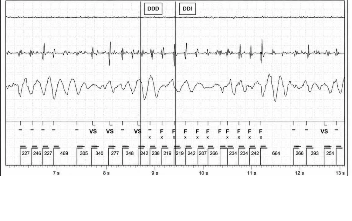 Abbott ICD electrogram, segment 20 of 29 — Acceleration of VT by anti-tachycardia pacing and high defibrillation threshold