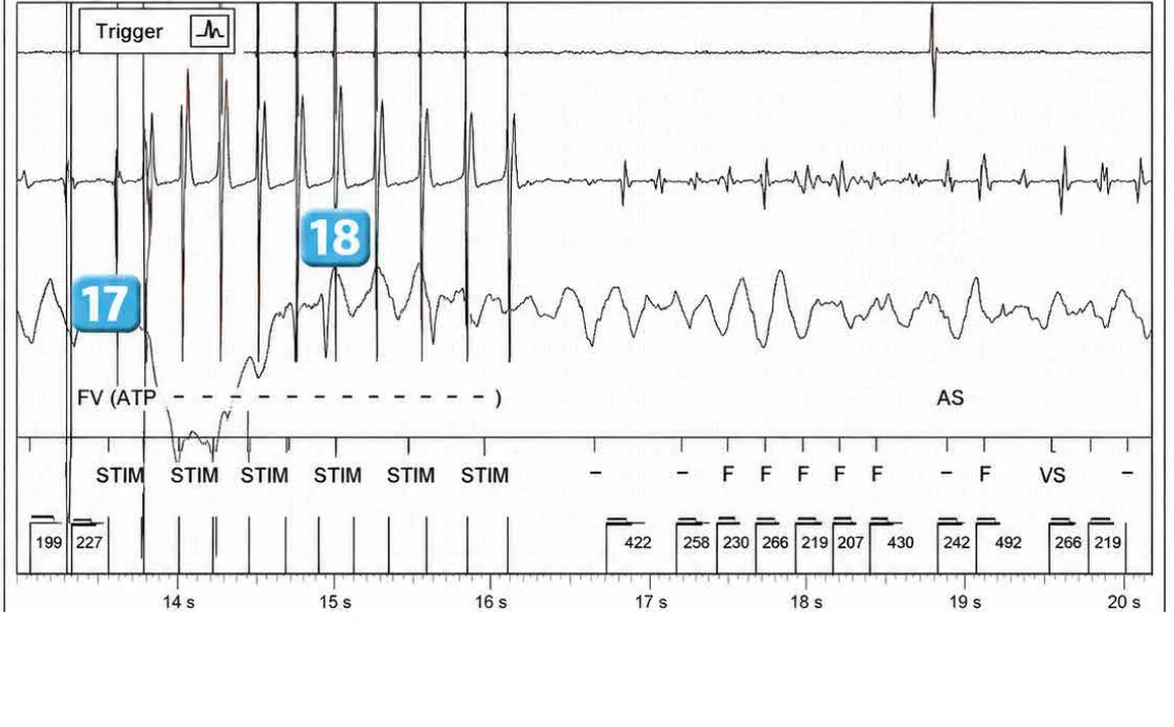 Abbott ICD electrogram, segment 21 of 29 — Acceleration of VT by anti-tachycardia pacing and high defibrillation threshold