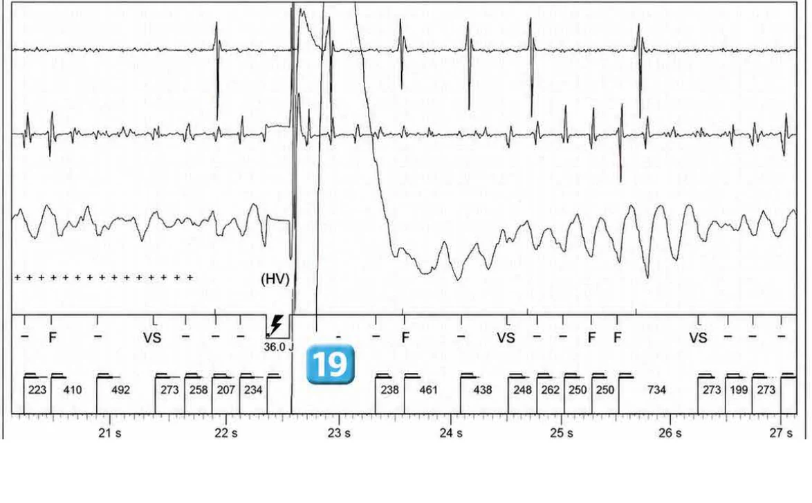 Abbott ICD electrogram, segment 22 of 29 — Acceleration of VT by anti-tachycardia pacing and high defibrillation threshold
