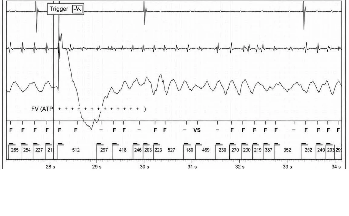 Abbott ICD electrogram, segment 23 of 29 — Acceleration of VT by anti-tachycardia pacing and high defibrillation threshold