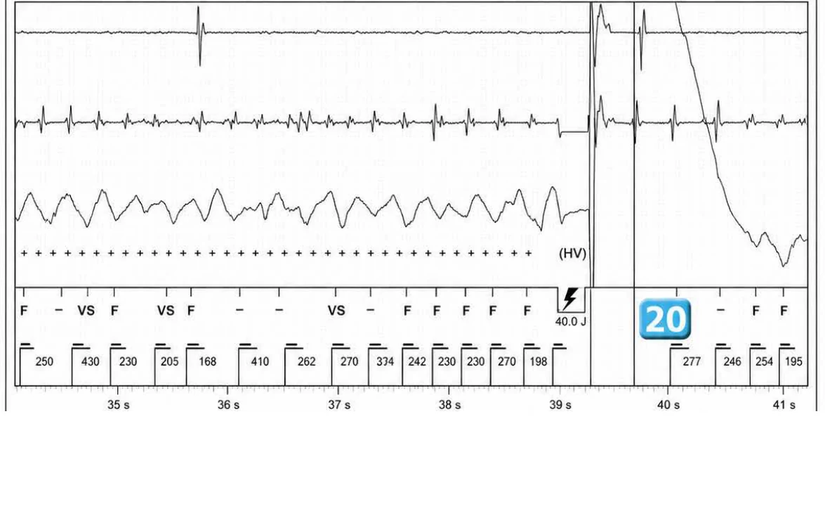 Abbott ICD electrogram, segment 24 of 29 — Acceleration of VT by anti-tachycardia pacing and high defibrillation threshold