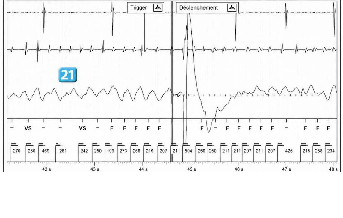 Abbott ICD electrogram, segment 25 of 29 — Acceleration of VT by anti-tachycardia pacing and high defibrillation threshold